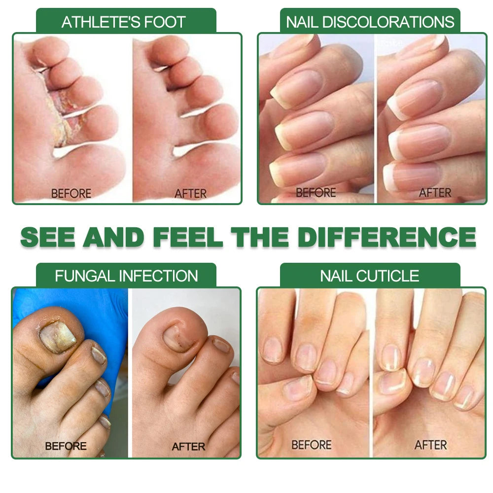 7 Days Fungal Nail Treatment Serum - Anti-Infection & Repair Gel