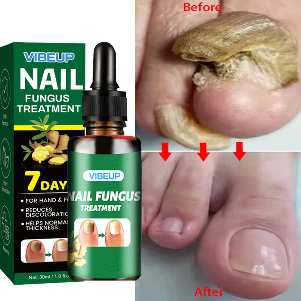 7 Days Fungal Nail Treatment Serum - Anti-Infection & Repair Gel