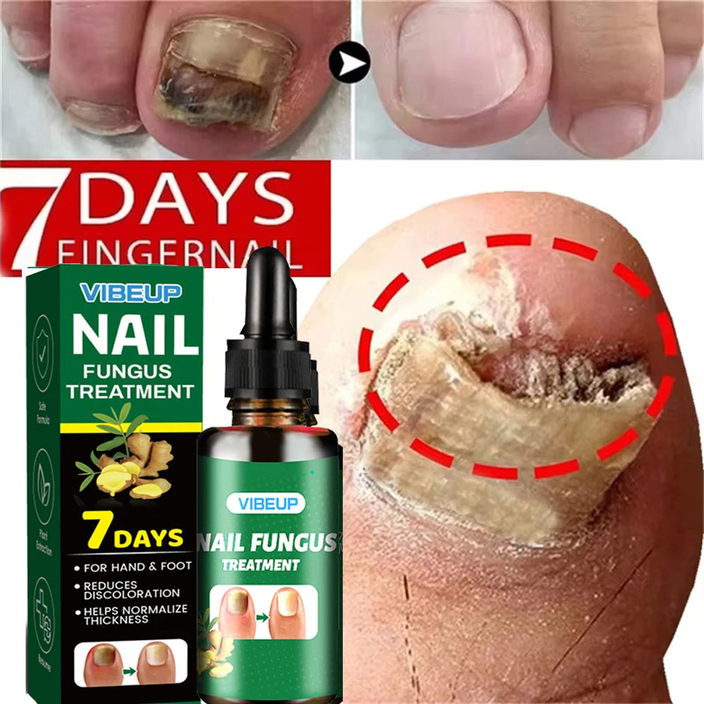 7 Days Fungal Nail Treatment Serum - Anti-Infection & Repair Gel