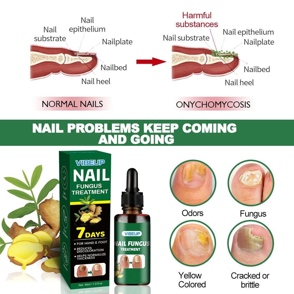 7 Days Fungal Nail Treatment Serum - Anti-Infection & Repair Gel