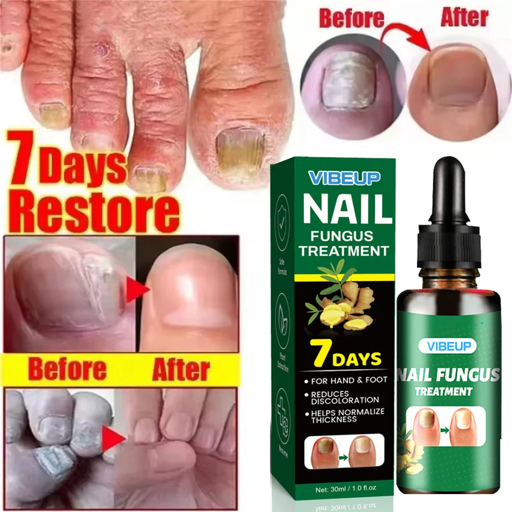 7 Days Fungal Nail Treatment Serum - Anti-Infection & Repair Gel